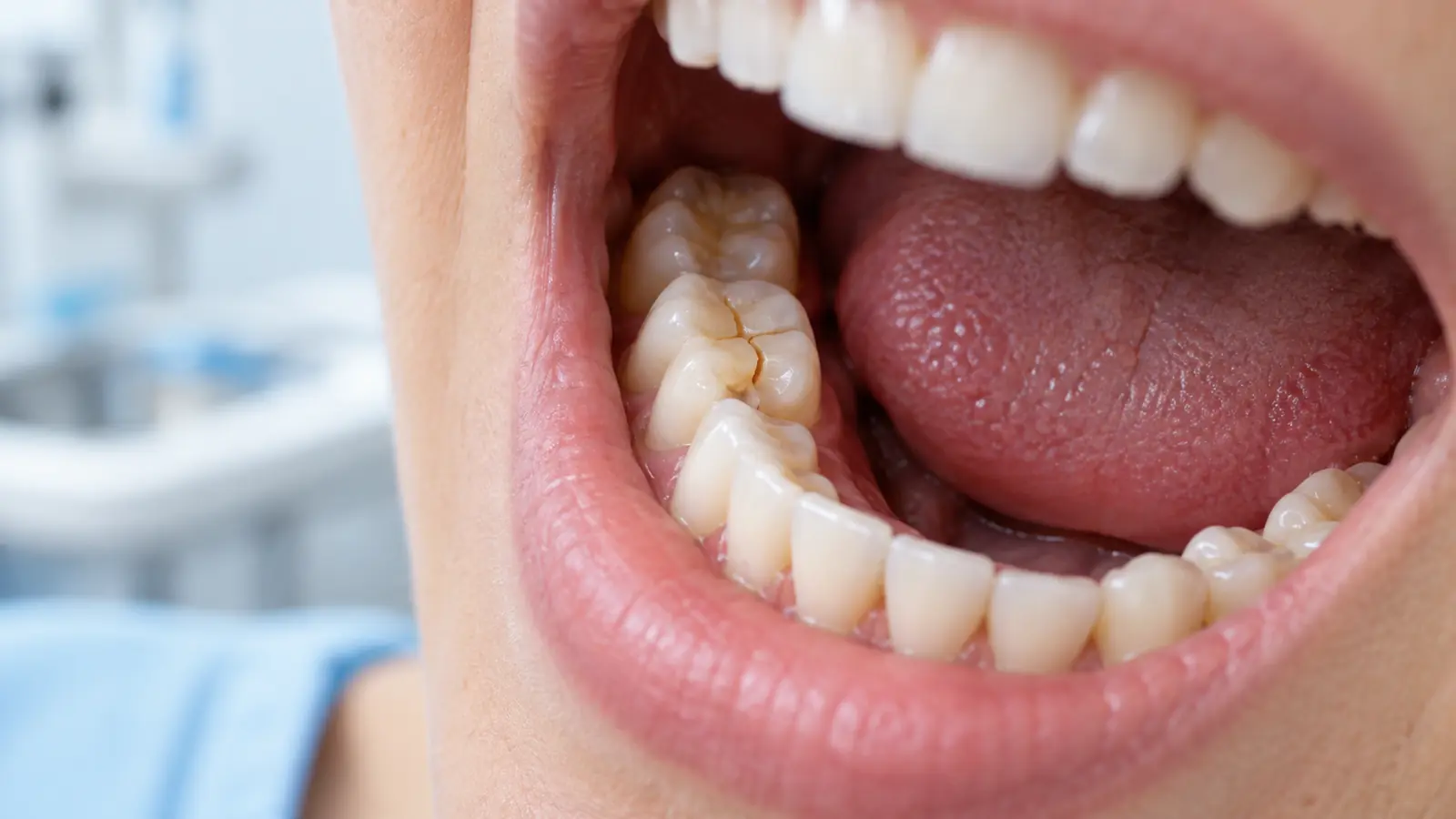Woman has a crack on her bottom right molar.