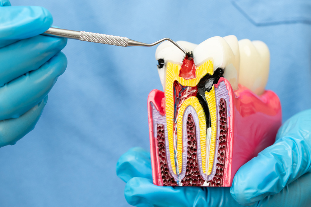 Root canals procedure explanation and treatment at Foresto Dentistry Windsor
