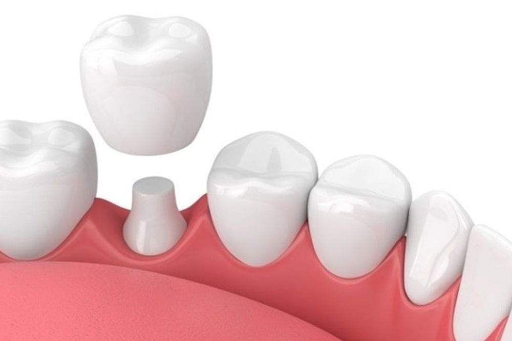 Illustration of a dental crown that has come loose from a tooth